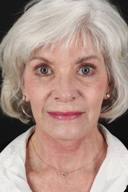 Neck Lift Before & After Patient #6665