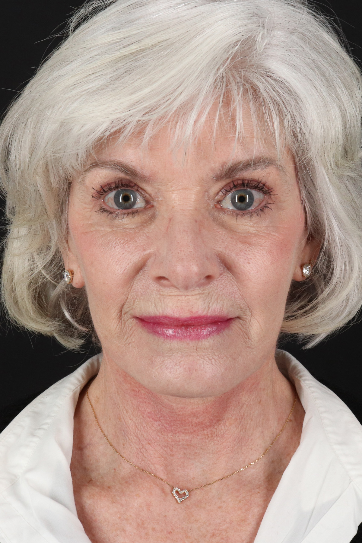 Neck Lift Before & After Patient #6665