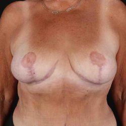 Breast Reduction With Lift Before & After Patient #3312