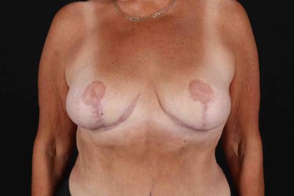 Breast Reduction With Lift Before & After Patient #3312