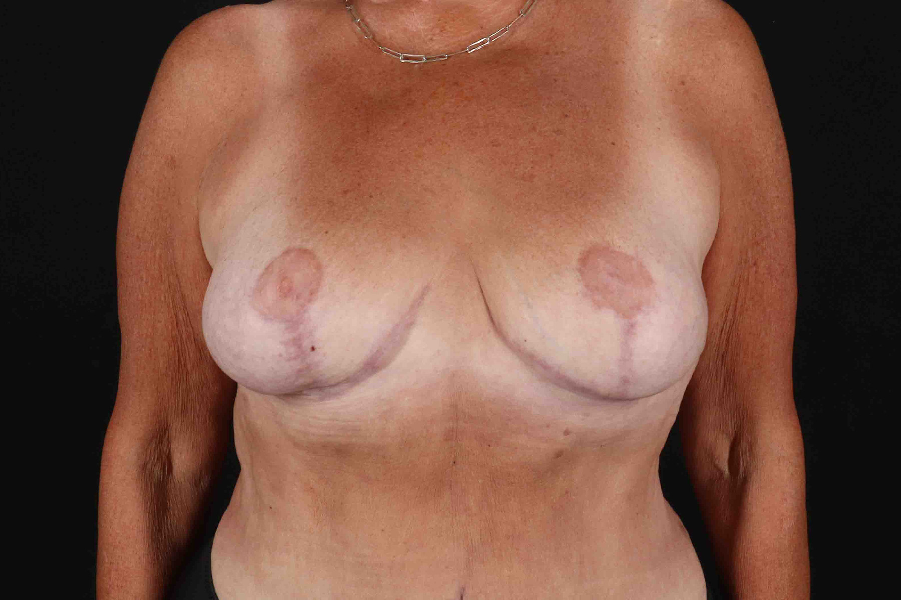 Breast Reduction With Lift Before & After Patient #3312