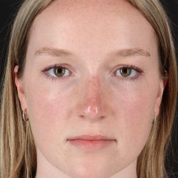Liquid Rhinoplasty Before & After Patient #6425