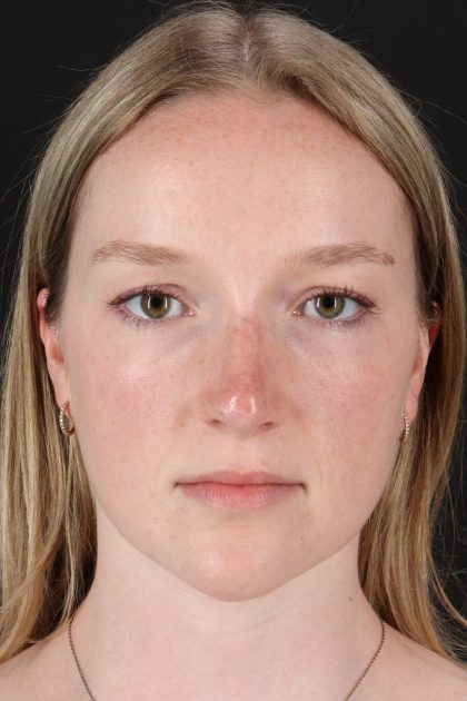 Liquid Rhinoplasty Before & After Patient #6425