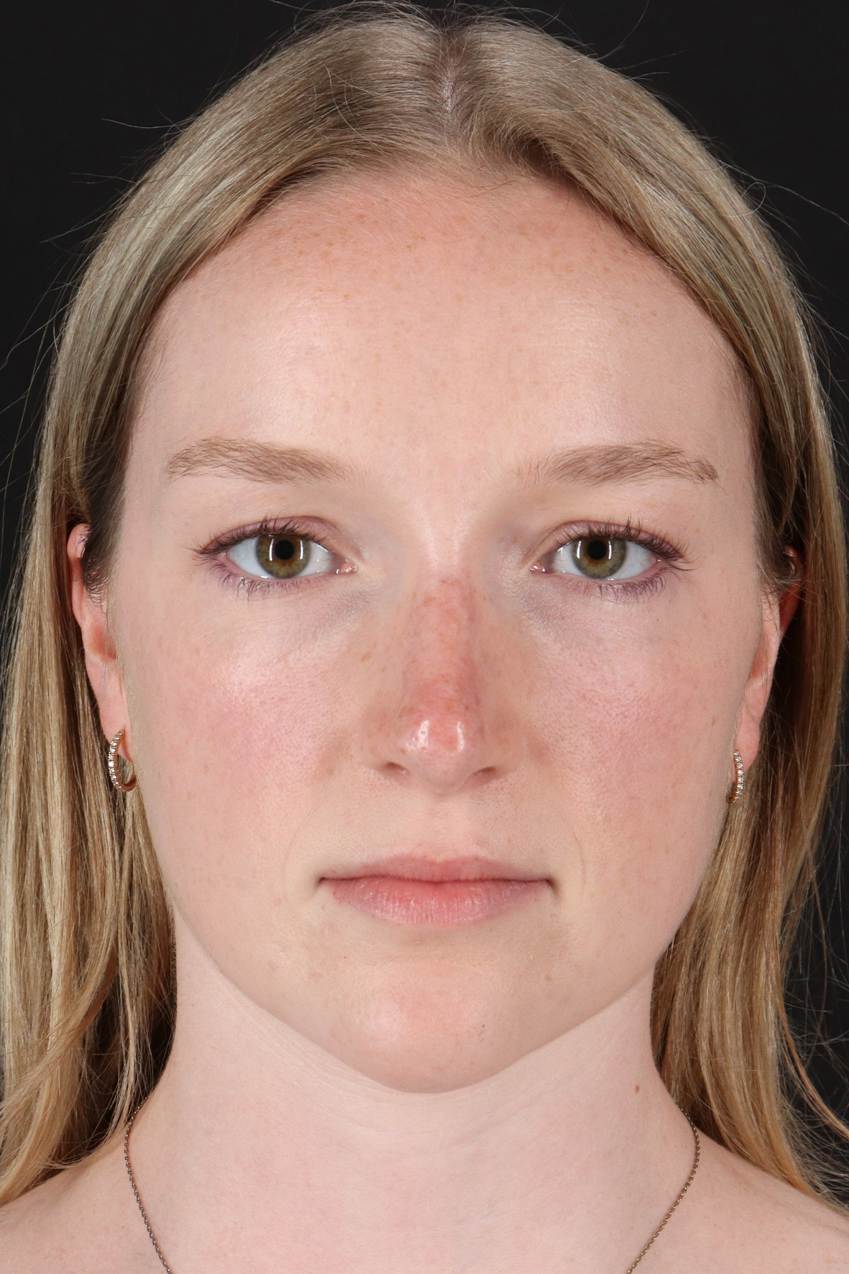Liquid Rhinoplasty Before & After Patient #6425