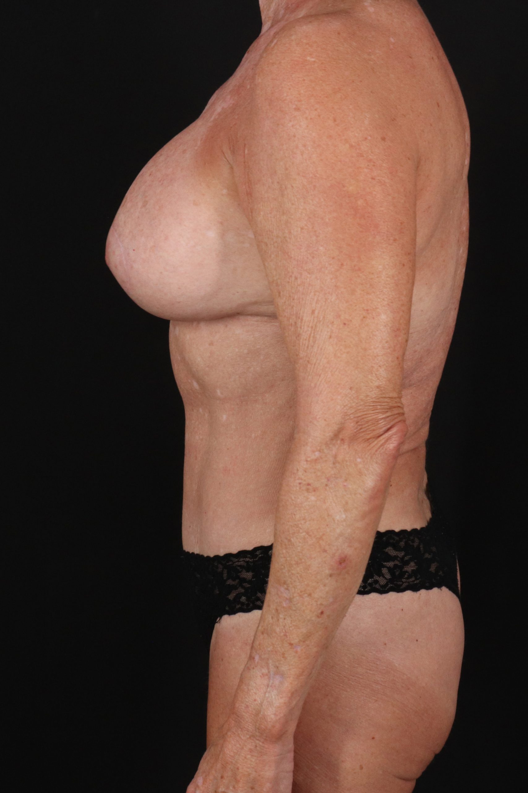All Me Augmentation Before & After Patient #2921