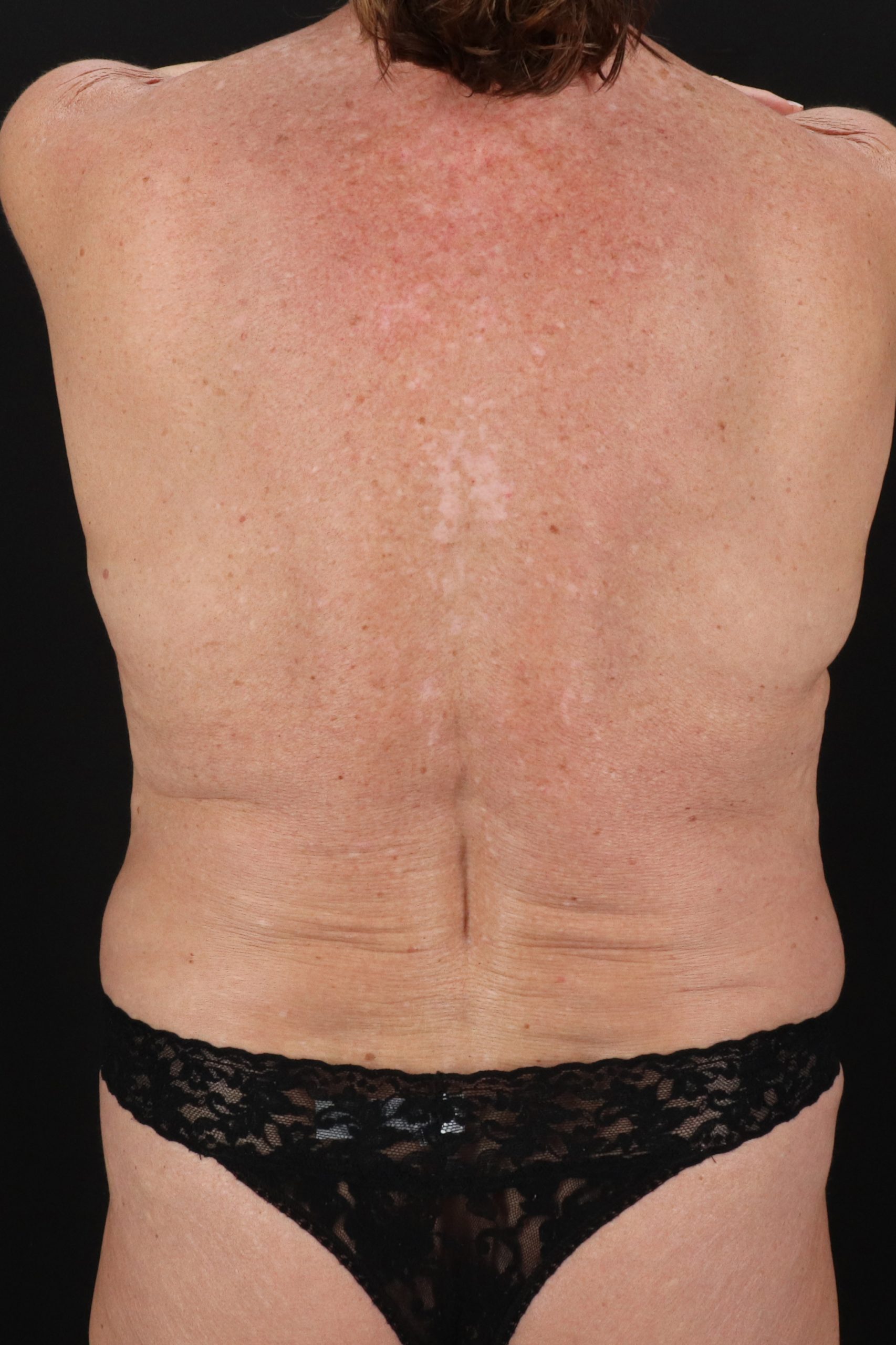 All Me Augmentation Before & After Patient #2921