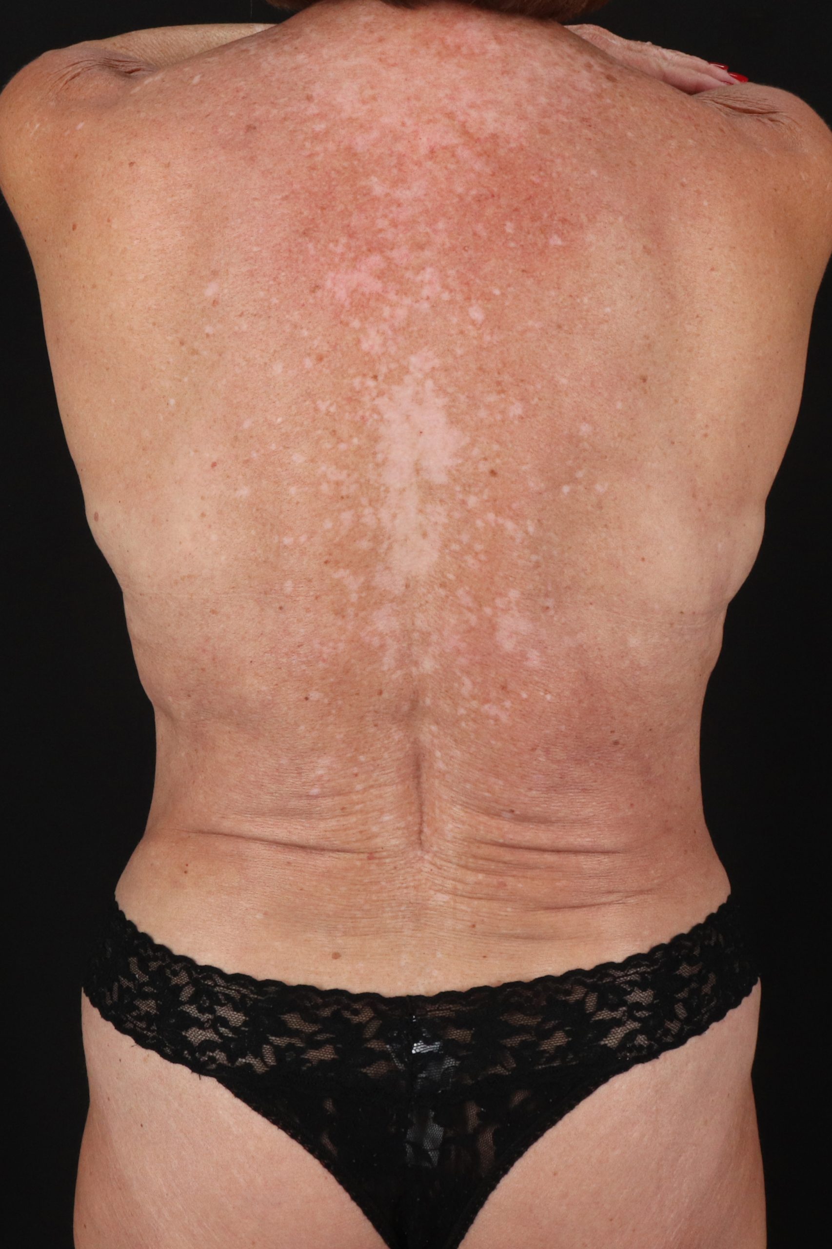 All Me Augmentation Before & After Patient #2921