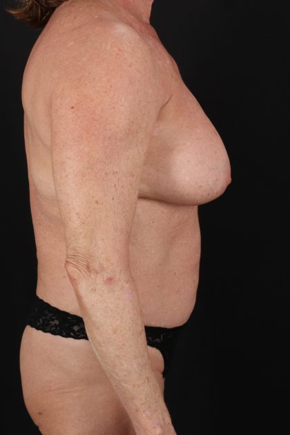 All Me Augmentation Before & After Patient #2921