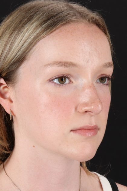 Liquid Rhinoplasty Before & After Patient #6425