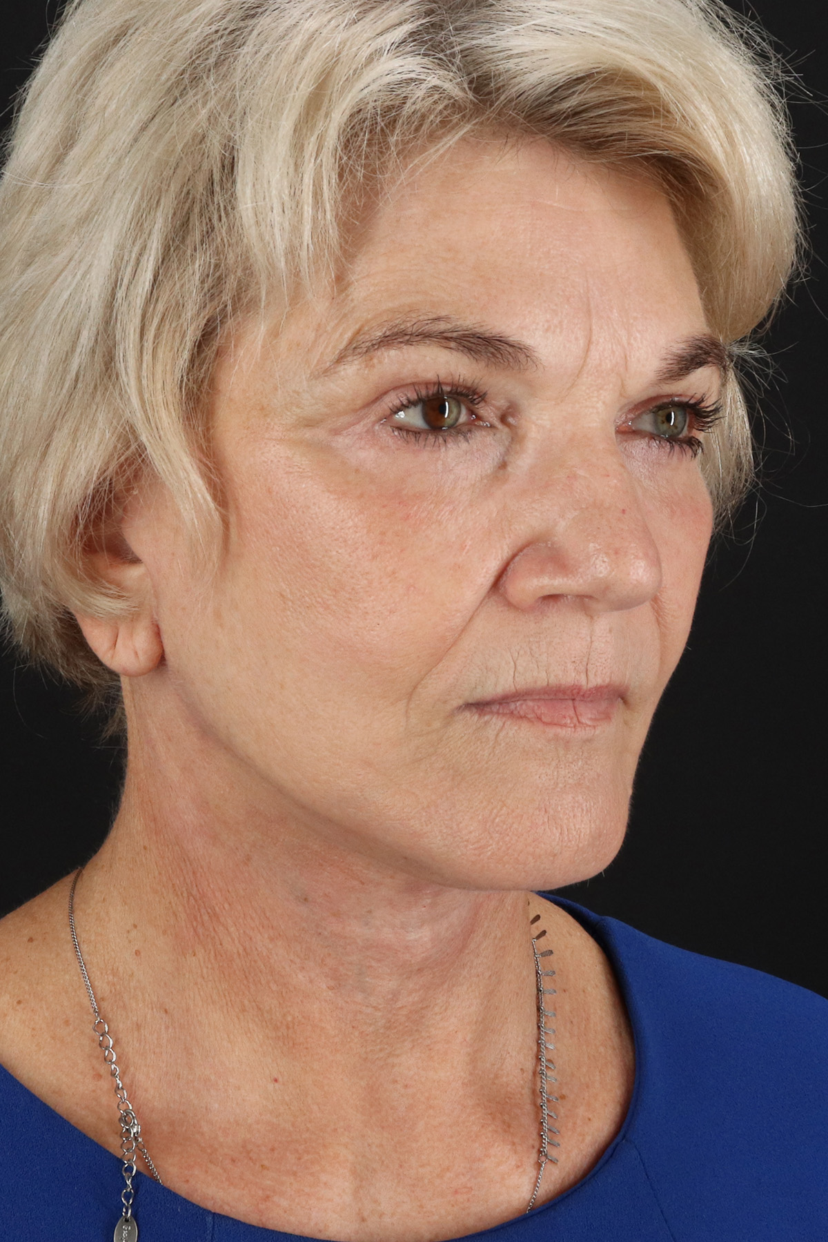 Neck Lift Before & After Patient #6654