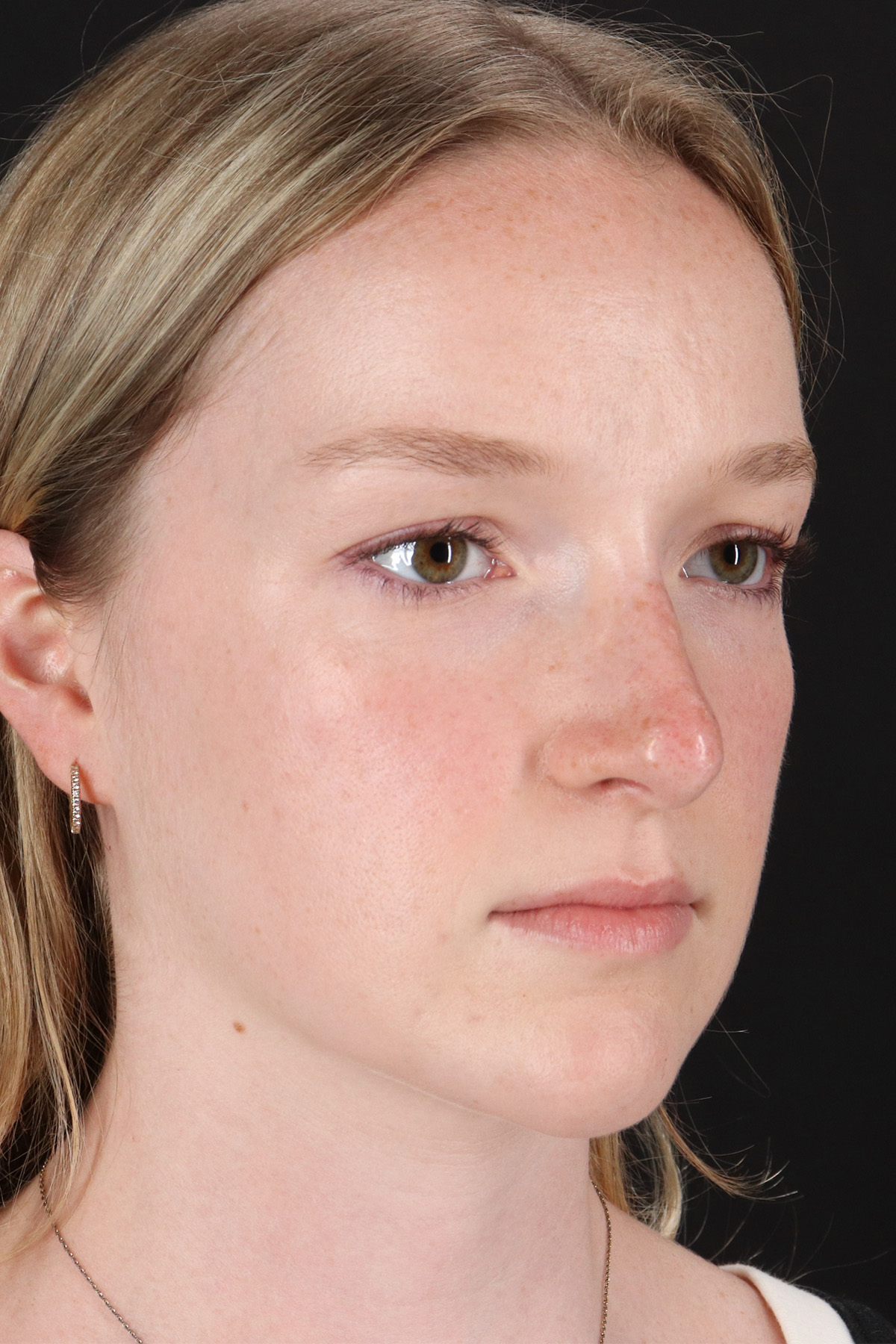 Liquid Rhinoplasty Before & After Patient #6425
