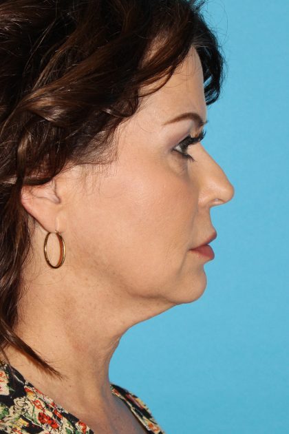 Neck Lift Before & After Patient #6546