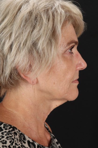 Neck Lift Before & After Patient #6654