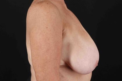 Breast Reduction With Lift Before & After Patient #3312