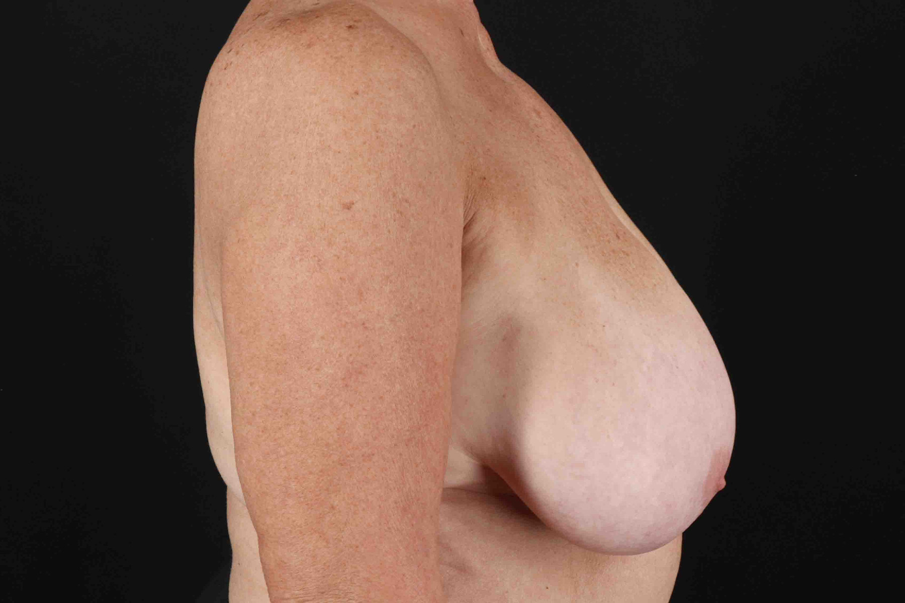 Breast Reduction With Lift Before & After Patient #3312