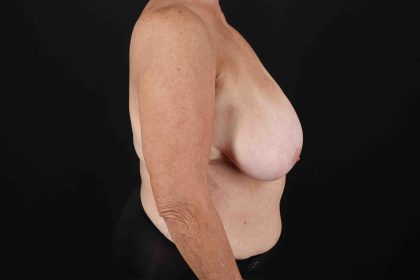 Mommy Makeover Before & After Patient #1584