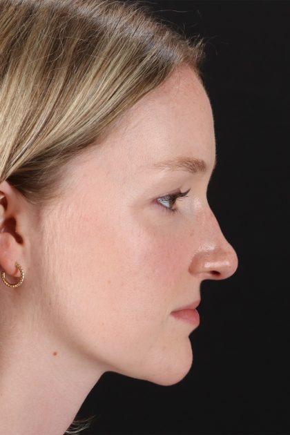 Liquid Rhinoplasty Before & After Patient #6425