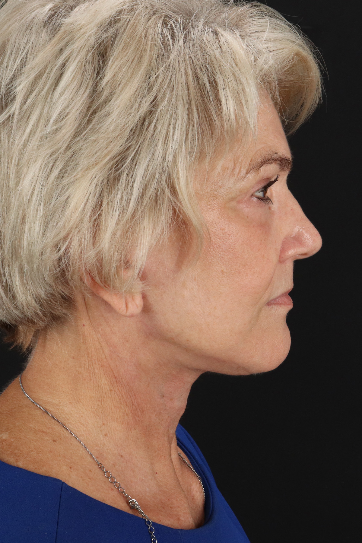Neck Lift Before & After Patient #6654