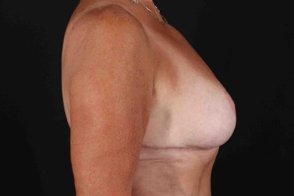 Breast Reduction With Lift Before & After Patient #3312
