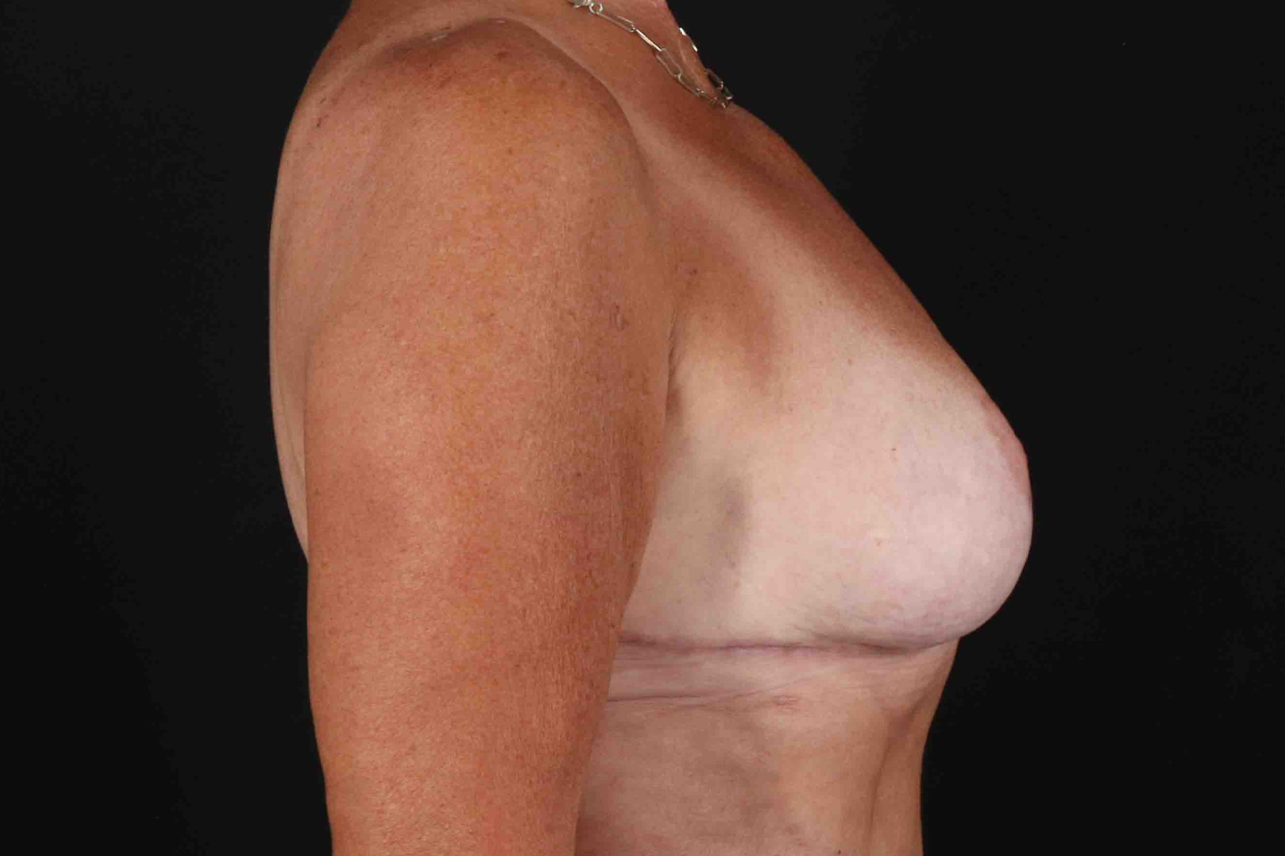 Breast Reduction With Lift Before & After Patient #3312