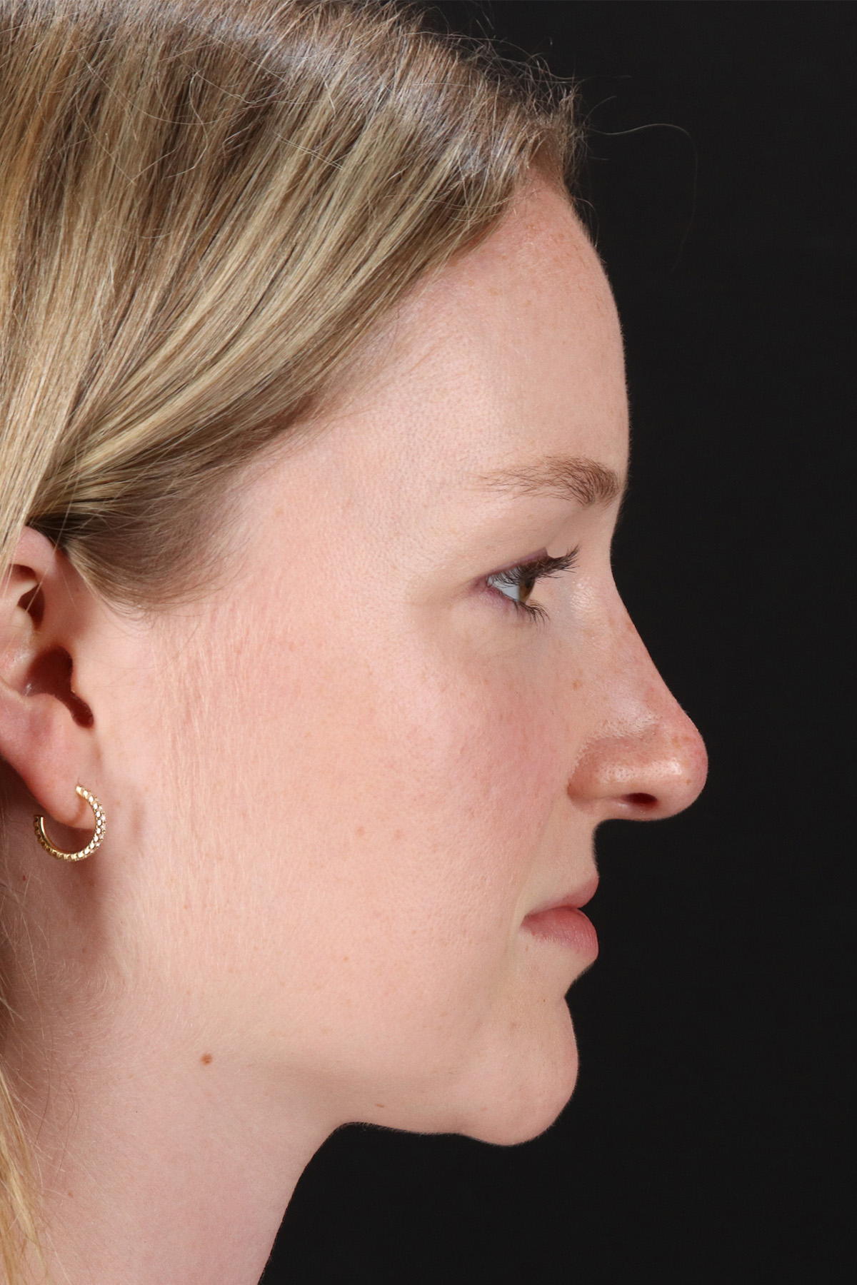 Liquid Rhinoplasty Before & After Patient #6425