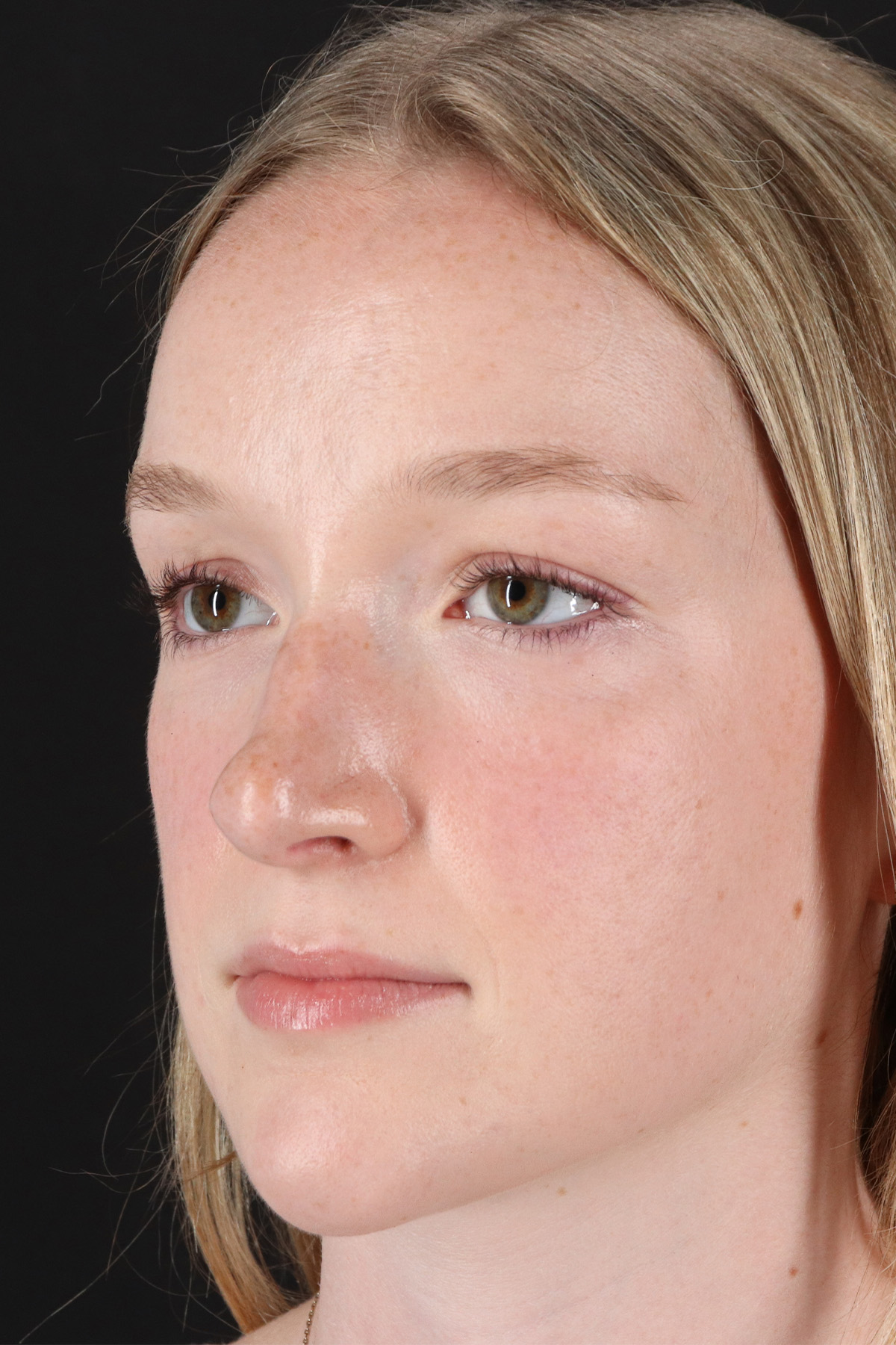 Liquid Rhinoplasty Before & After Patient #6425