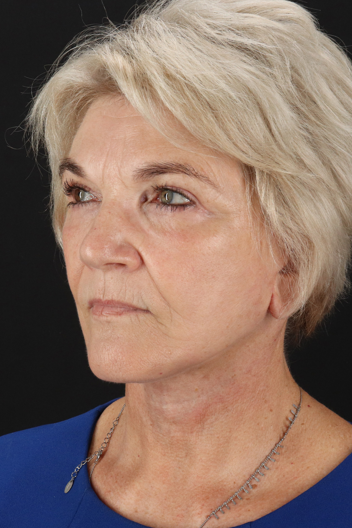 Neck Lift Before & After Patient #6654