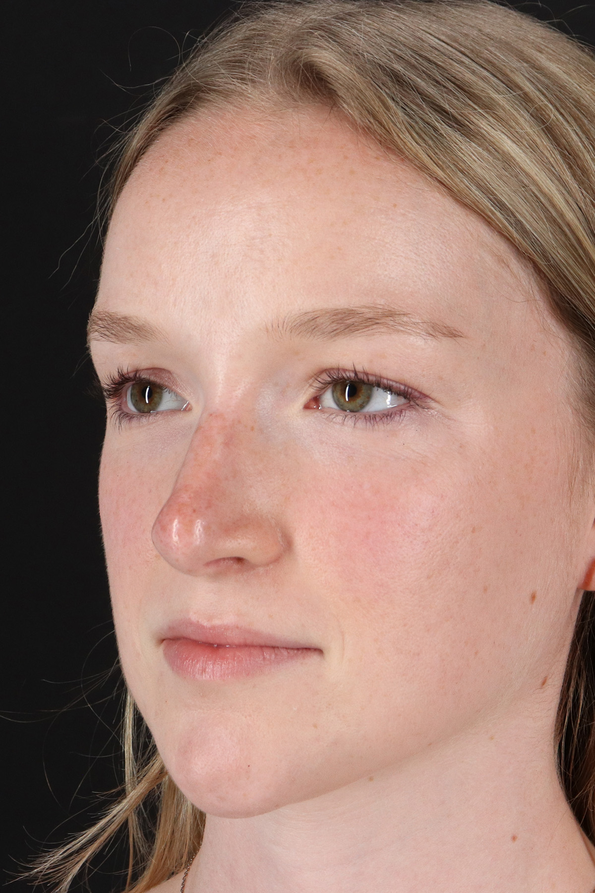 Liquid Rhinoplasty Before & After Patient #6425