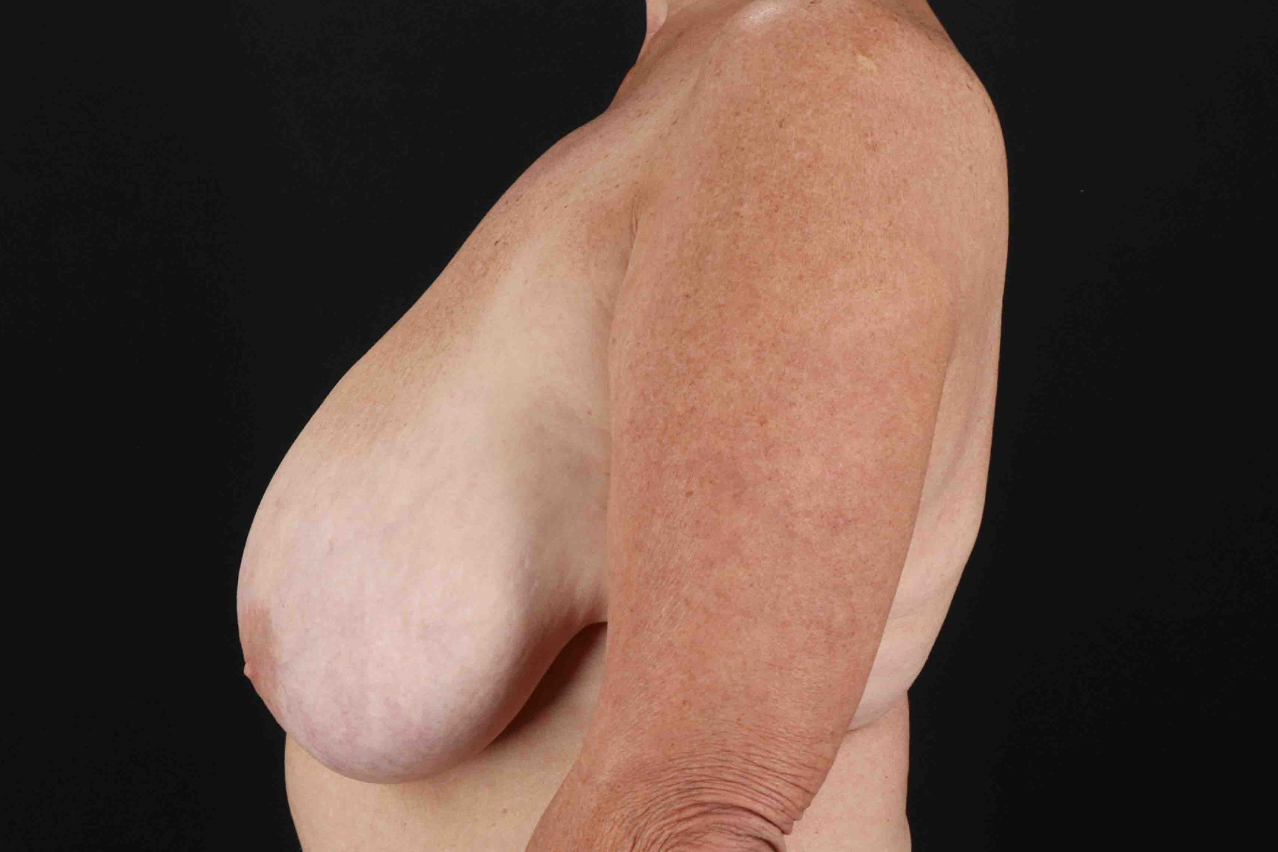 Breast Reduction With Lift Before & After Patient #3312