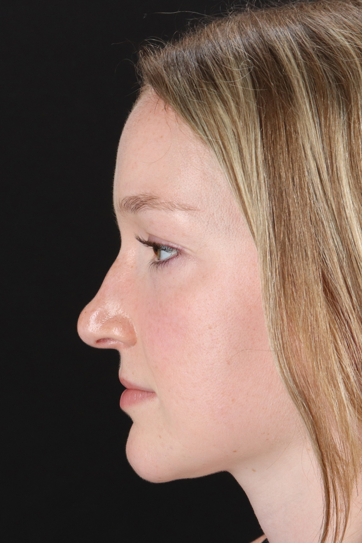 Liquid Rhinoplasty Before & After Patient #6425