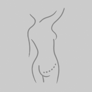 GAP Flap Breast Reconstruction, Houston TX, My Houston Surgeons