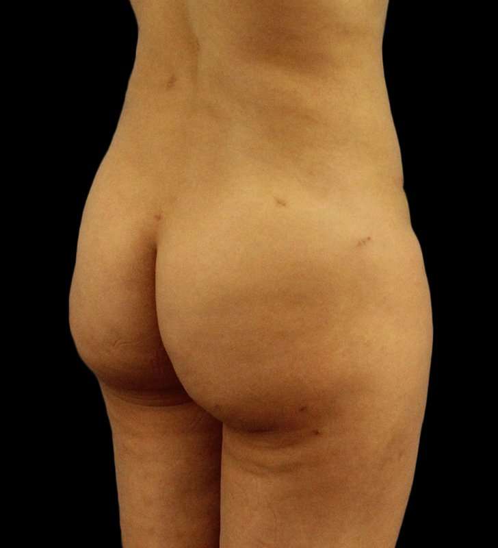 Brazilian Butt Lift Before & After Patient #557