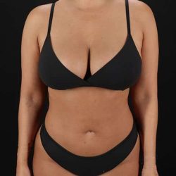 Liposuction Before & After Patient #1469