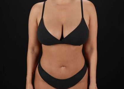 Liposuction Before & After Patient #1469