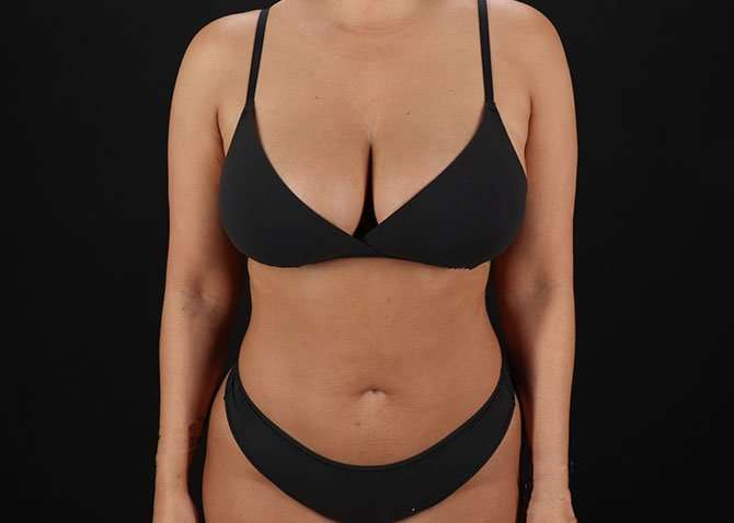 Liposuction Before & After Patient #1469