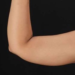 Liposuction Before & After Patient #1482