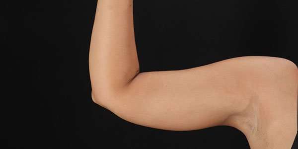 Liposuction Before & After Patient #1482
