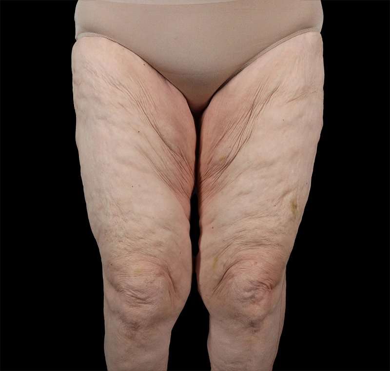 Liposuction Before & After Patient #1495