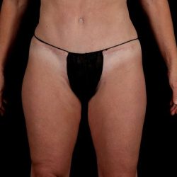 Liposuction Before & After Patient #1500