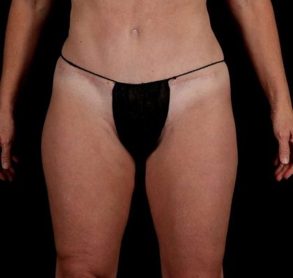Liposuction Before & After Patient #1500