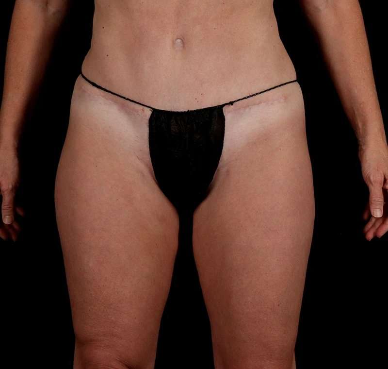 Liposuction Before & After Patient #1500