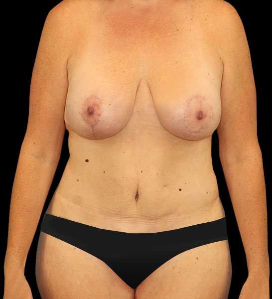 Mommy Makeover Before & After Patient #1535