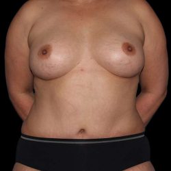 Mommy Makeover Before & After Patient #1547