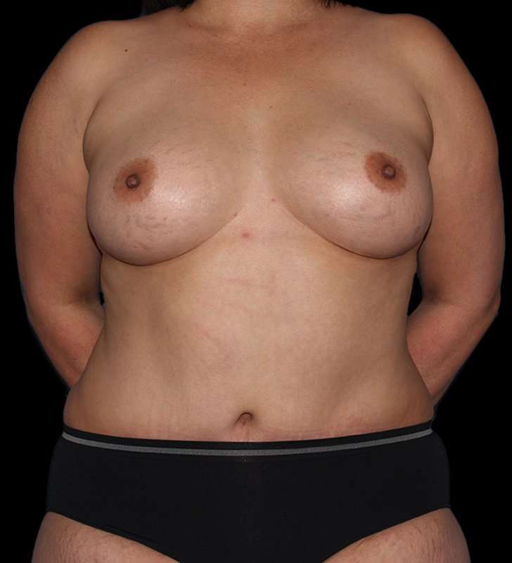 Mommy Makeover Before & After Patient #1547