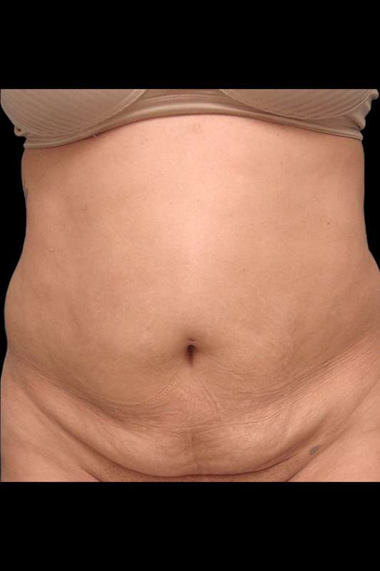 Abdominoplasty (Tummy Tuck) Before & After Patient #670