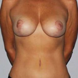 Mommy Makeover Before & After Patient #1658