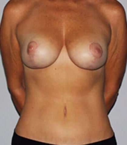 Mommy Makeover Before & After Patient #1658