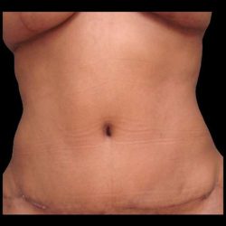 Abdominoplasty (Tummy Tuck) Before & After Patient #675
