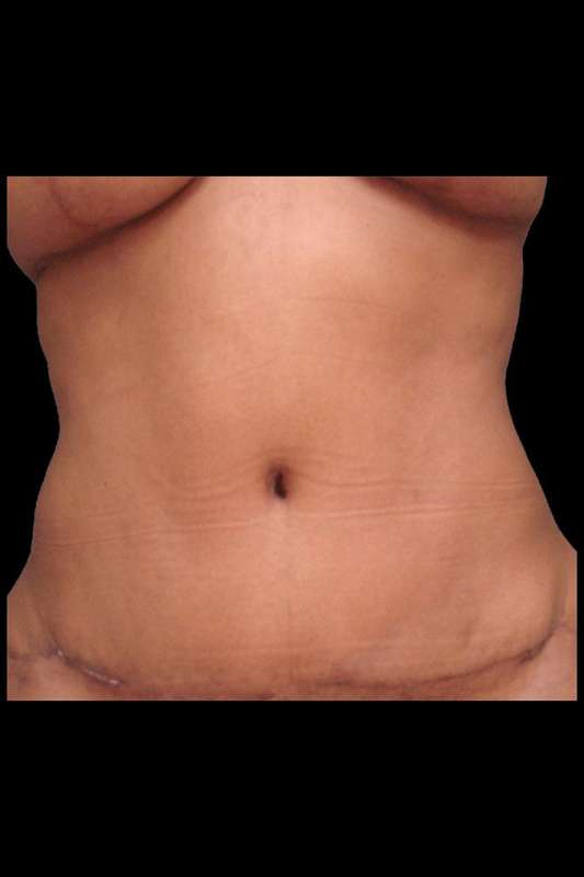 Abdominoplasty (Tummy Tuck) Before & After Patient #675