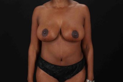 Mommy Makeover Before & After Patient #1751